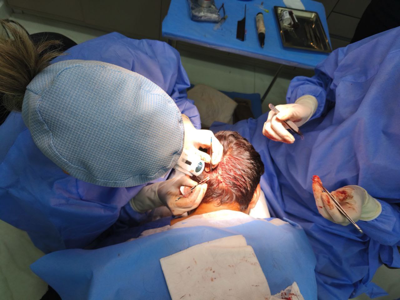Transplante FUE
